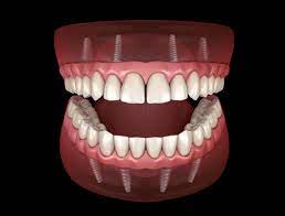 What Are Implant-Supported Dentures? - Smiles On Michigan Chicago Illinois